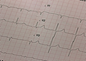 electrocardiograma, ekg